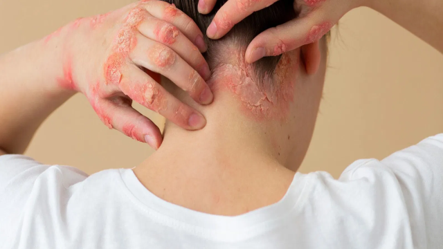 Berbagai Tanda dan Ciri-Ciri Penyakit Kulit yang Sering Diabaikan Banyak Orang